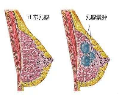 “乳头之痛：爱抚背后的乳腺囊肿谜团”