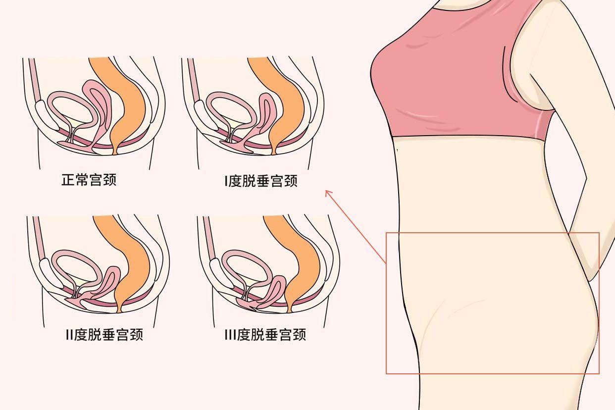 “Valsalva产后议题”：笑谈科技圈的新“悬浮”热点